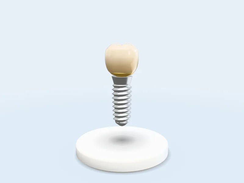 Chiếc răng implant đã ghép liền: mão sứ trắng ngà ngồi khít trên khớp nối và trụ titan, đứng trên bệ tròn trắng dưới đèn mềm